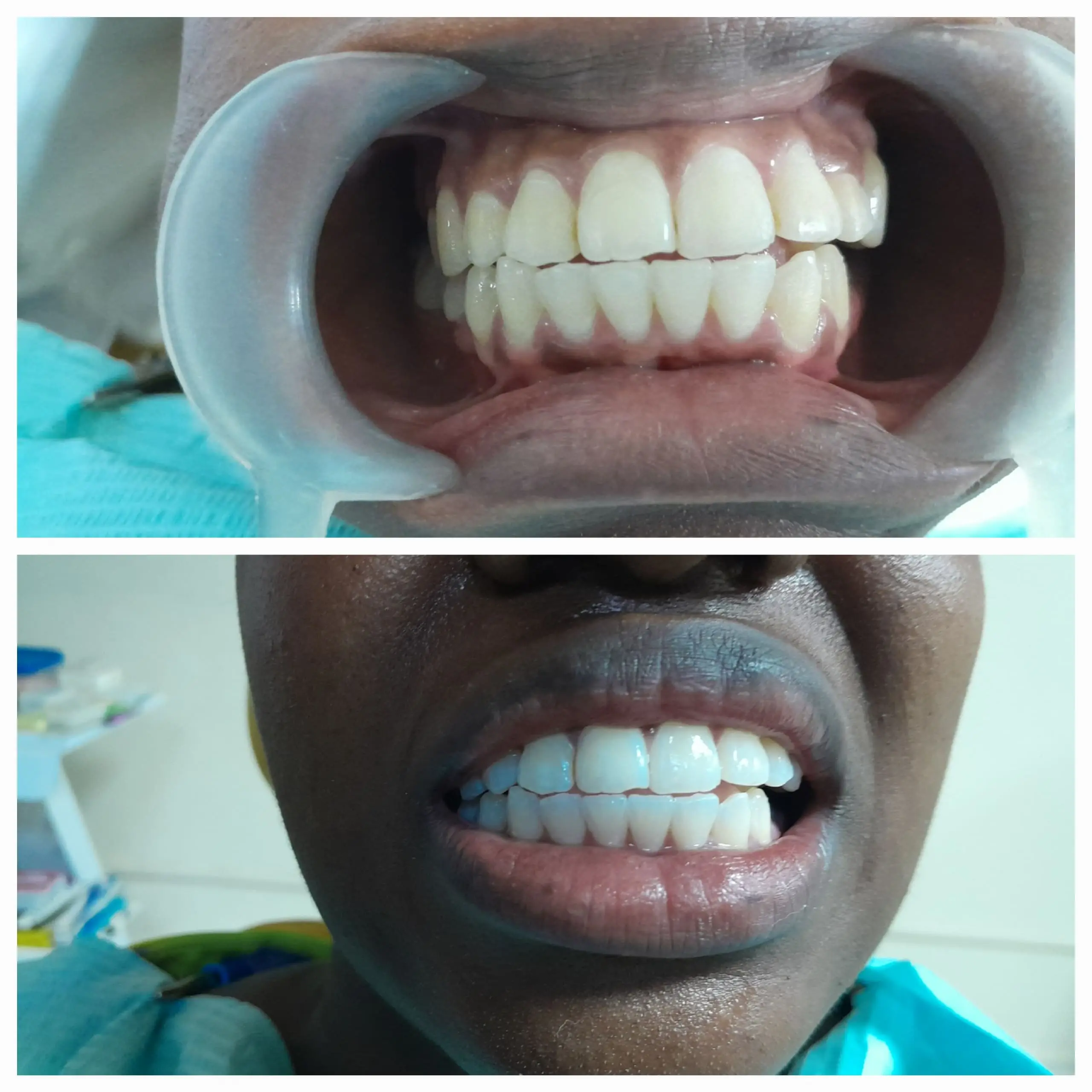 Teeth Whitening done at Sterling Dental Clinic
